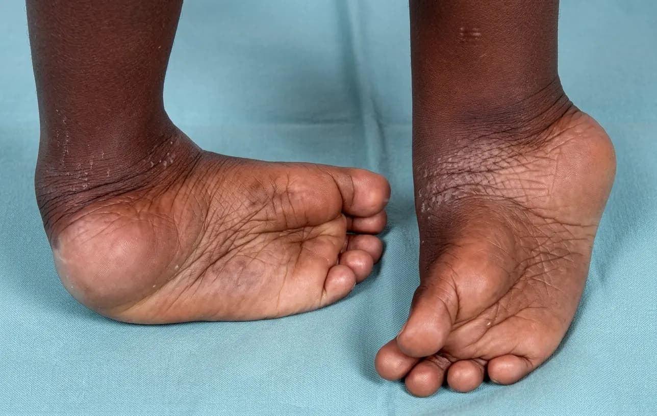 Santé en Côte d’Ivoire : des progrès encourageants dans la prise en charge du pied bot